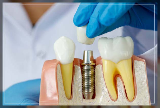 Dental implant in Dubai 3