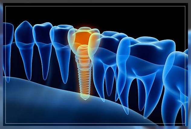 Dental implant in Dubai 7