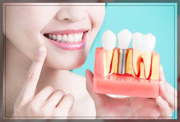 Dental implants in Dubai 1