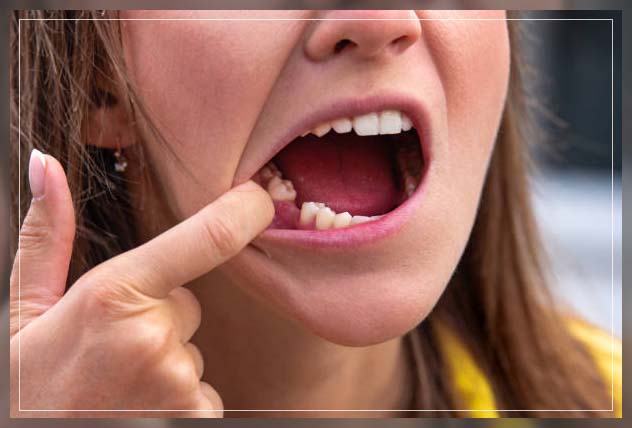 Dental implants in Dubai 4