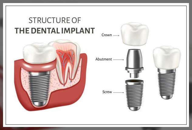 Dental implants in Dubai 22