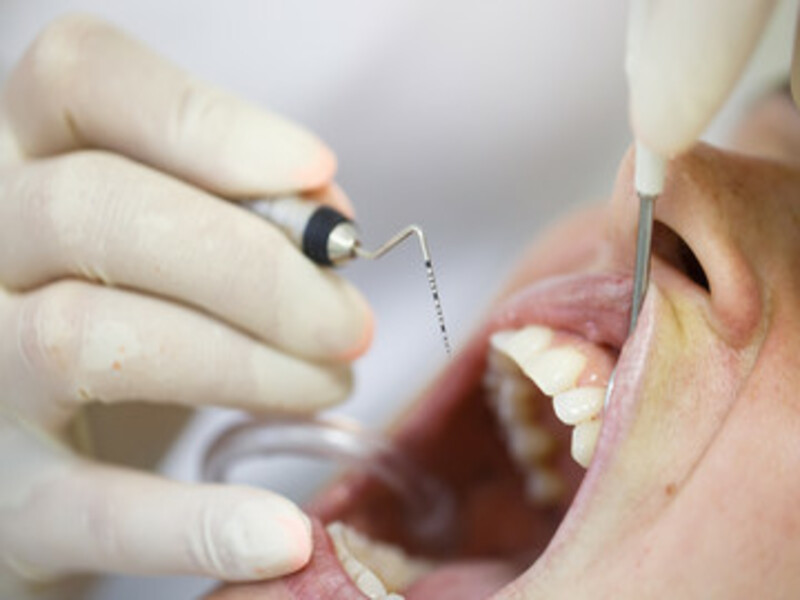 what is Periodontal Probe