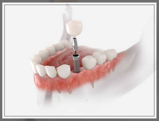 dental implants 2