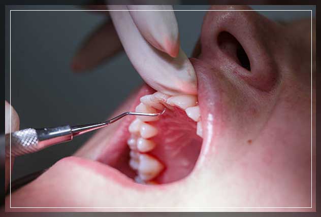 using the dental Gracey curette
