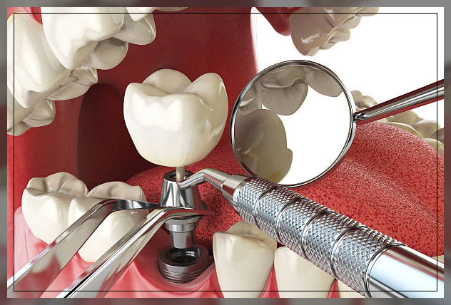 Tooth implant 1