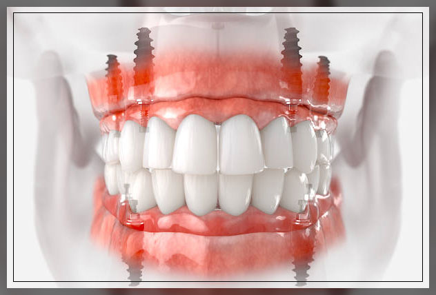 Tooth implant 5