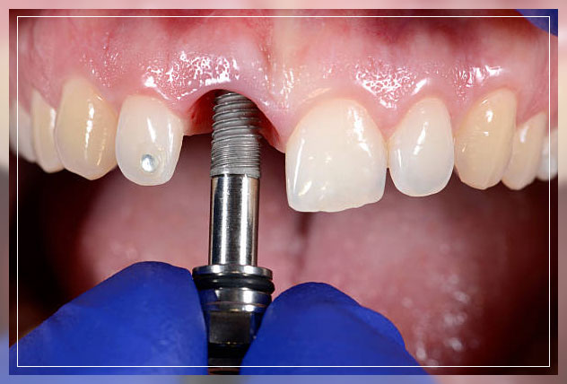 Tooth implant 6