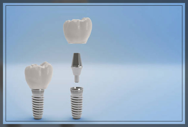 Tooth implant 7