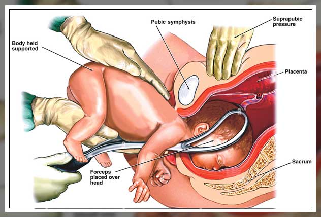 what is forceps delivery
