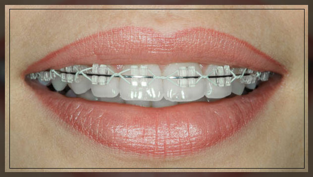 Ceramic braces 1