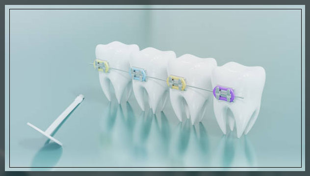 Ceramic braces 4