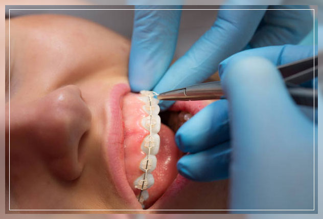 Ceramic braces 5