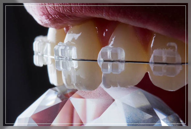 Ceramic braces 6