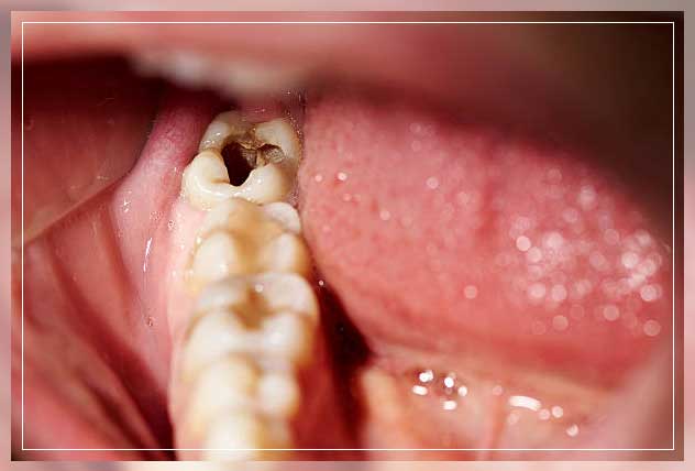 what are cavities in teeth