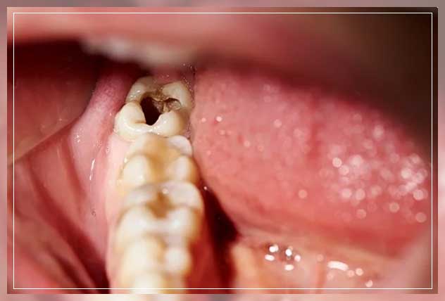 what are the tooth decay stages