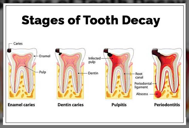 tooth decay stages to know