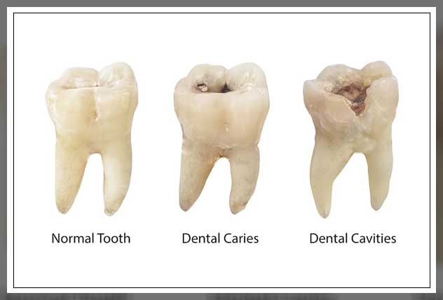 how tooth decay happens
