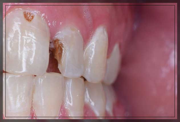 controlling tooth decay 