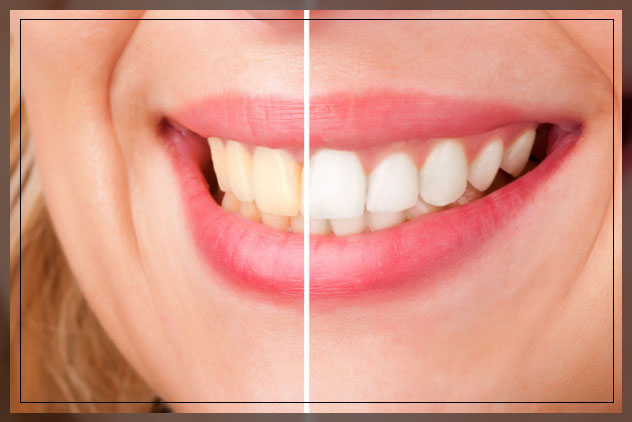 bleach or teeth whitening?