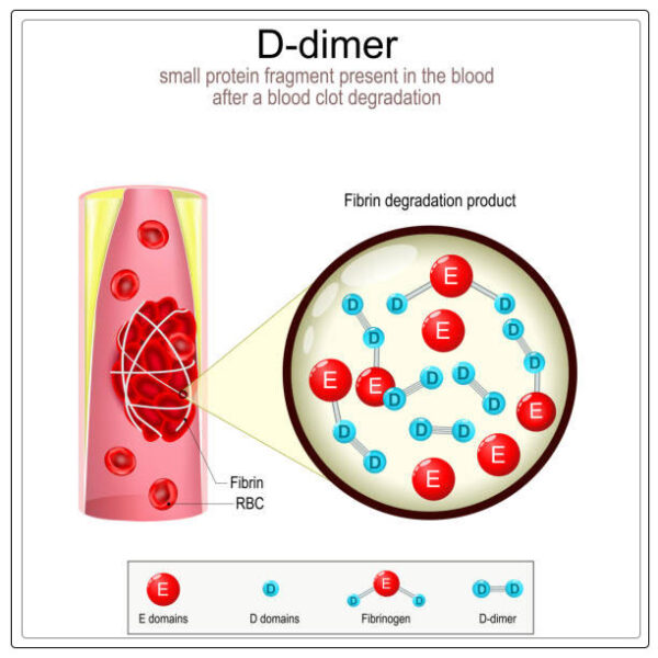 D Dimer Test Definition, Diagnosis, and What to Expect Egiomed