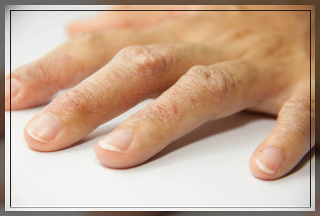 latex allergy 2