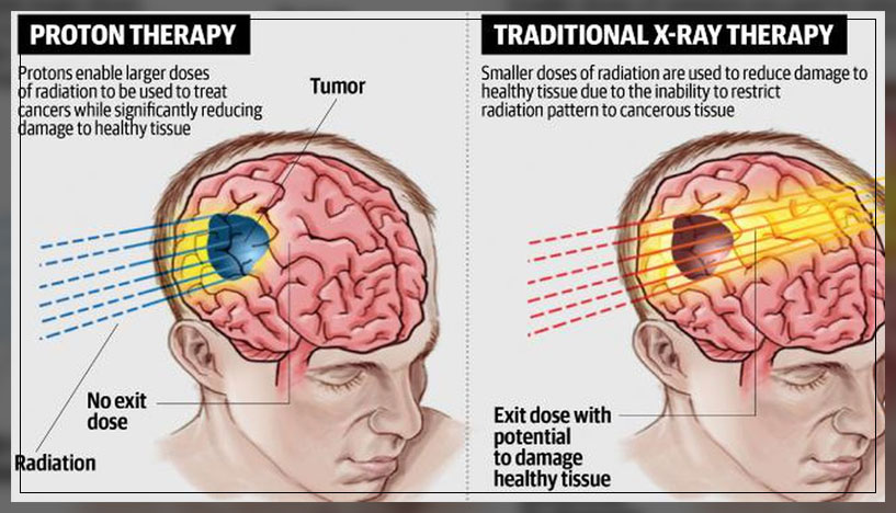the proton therapy treatment
