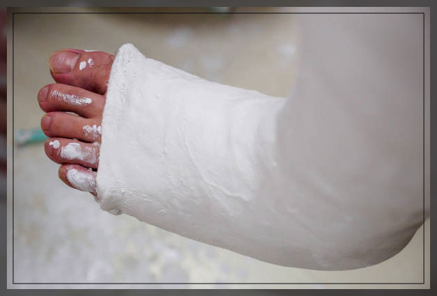 Plaster of Paris Bandage: When Do You Need It? - Engiomed