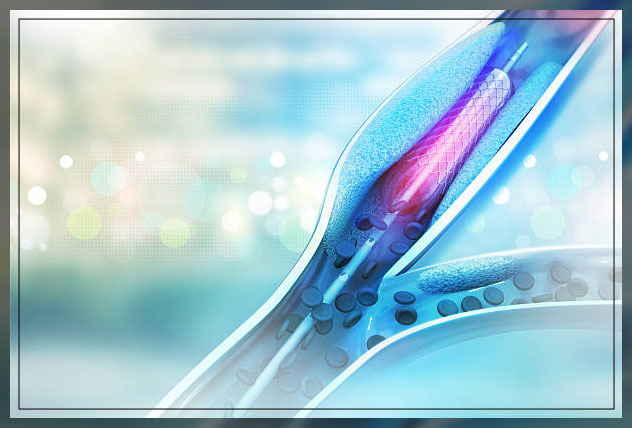 angioplasty procedure