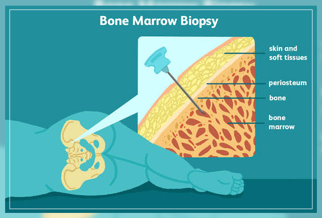 bone marrow biopsy