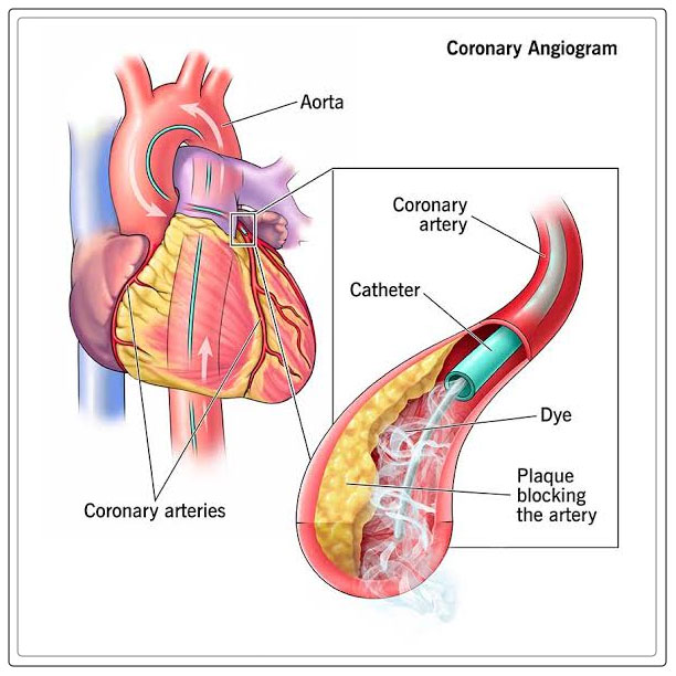 coronary angiography 1