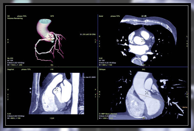 coronary angiography 2