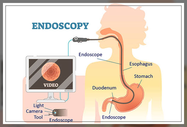 endoscopic biospy