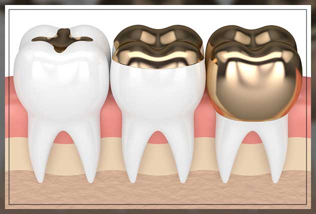 gold fillings procedure