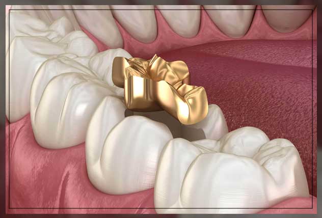 gold fillings pros and cons
