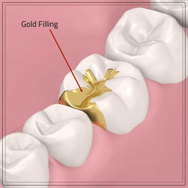 gold fillings placement