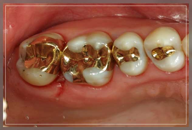 gold fillings