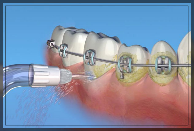 using dental picks