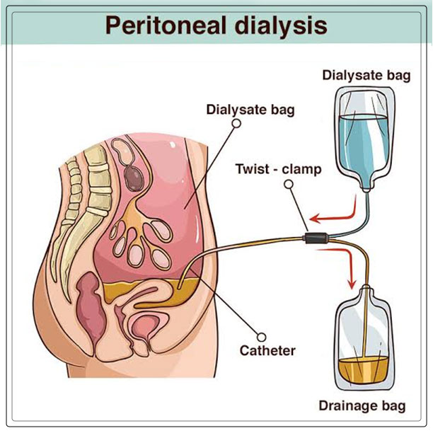 kidney dialysis 2