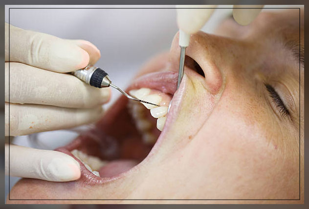 scaling periodontal instruments